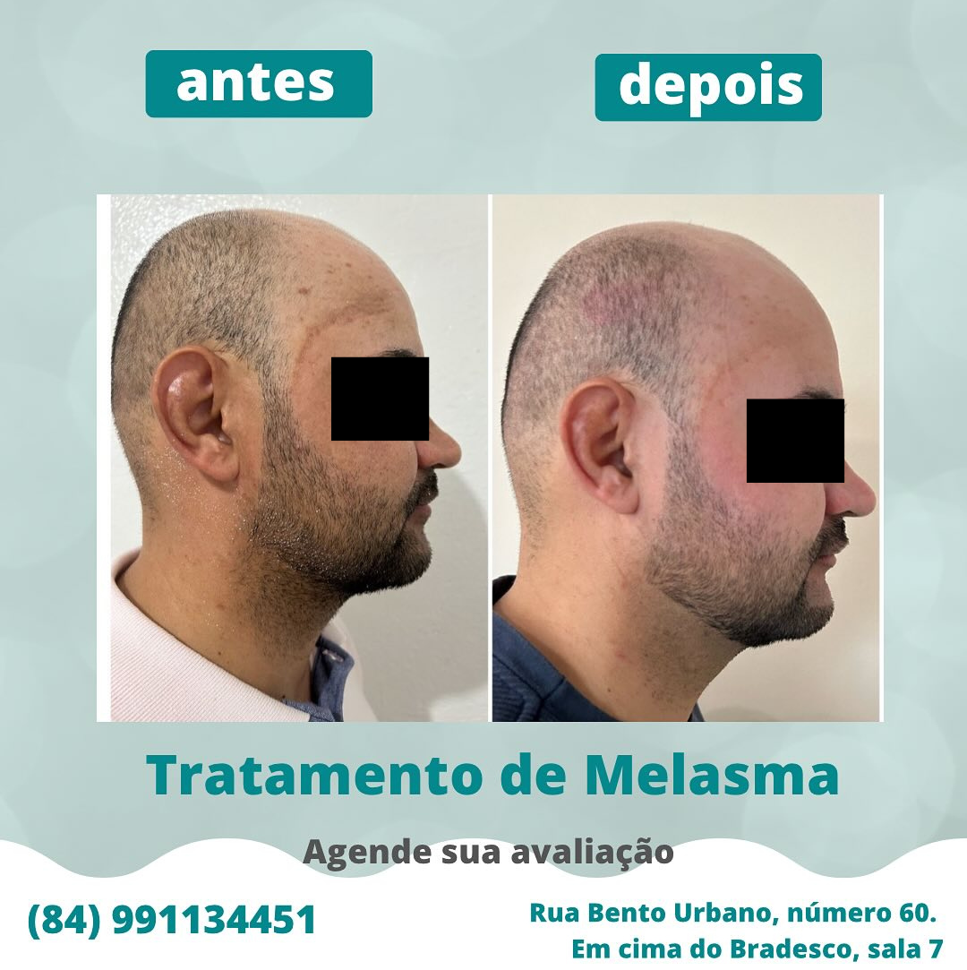 Caso de melasma cuidado - Foto 5